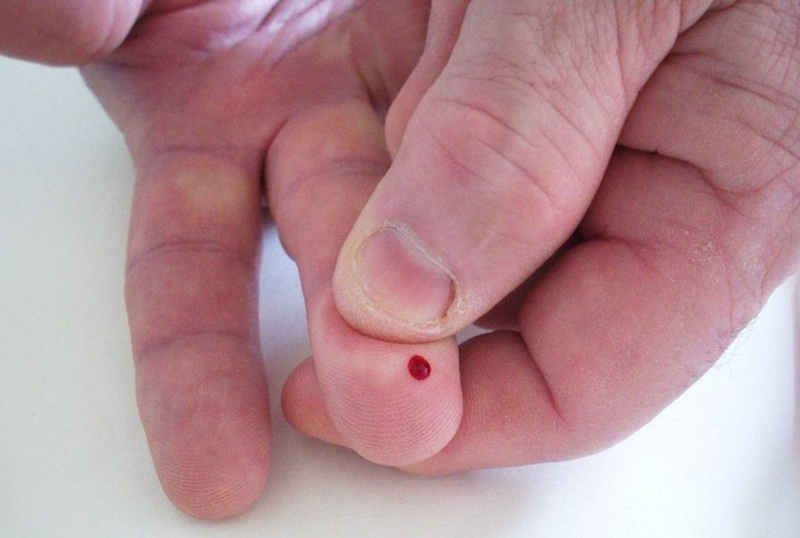 Der Stich in die Fingerbeere für den Blutzuckertest gehört für viele Diabetiker zum Alltag. (Foto: Flickr, AlishaV, Creative Commons-Lizenz